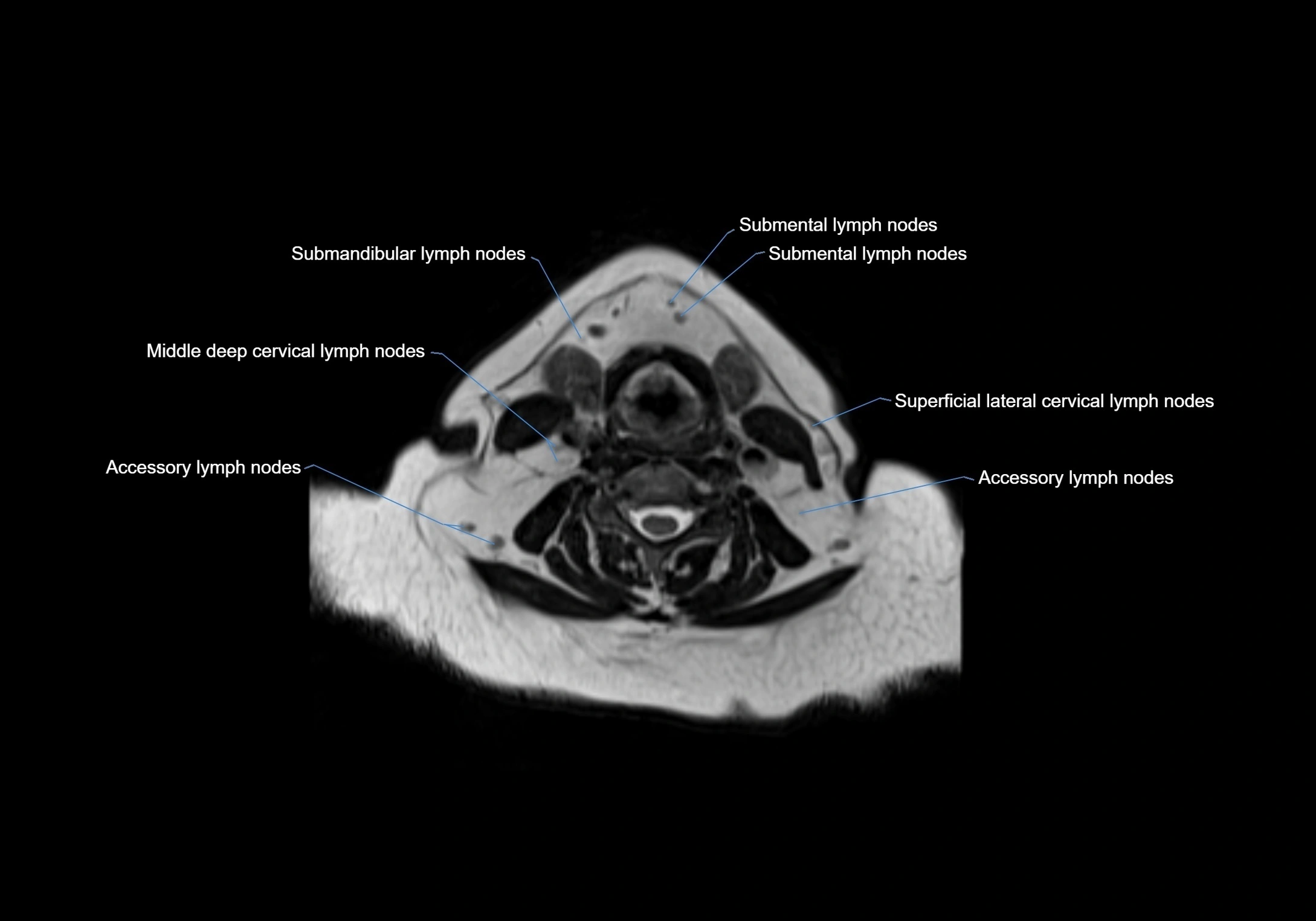 Neck axial  lymph node cross sectional MRI anatomy 3T MRI  image-img-00001-00060.webp